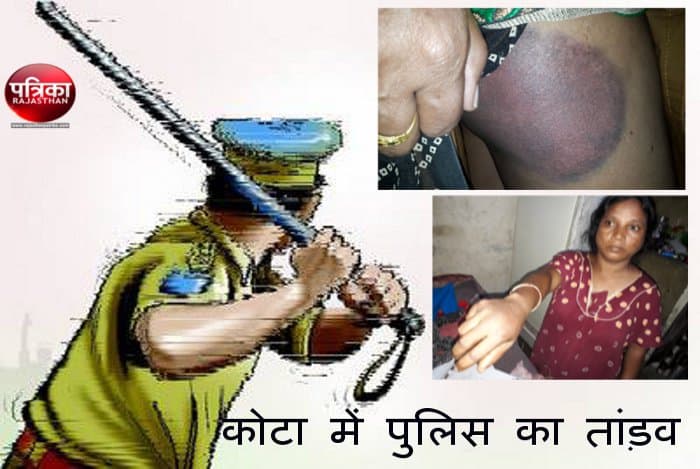 Lathi charge in Kota, Illegal custody Kota, Kota Police, Crime In Kota, SP City Kota, Anshuman Bhomiya, Anantapura Police Station, Ajay Ahuja Nagar Kota, Kota police beat up innocents