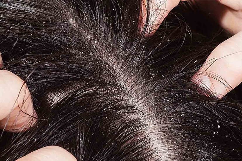 home-remedies-for-dandruff.jpg