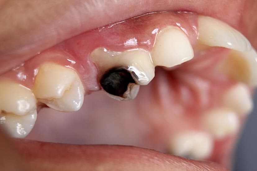 tooth-cavity-in-children.jpg