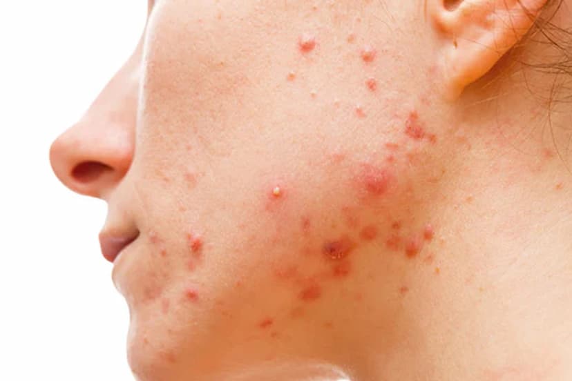 acne-causes-on-face.jpg