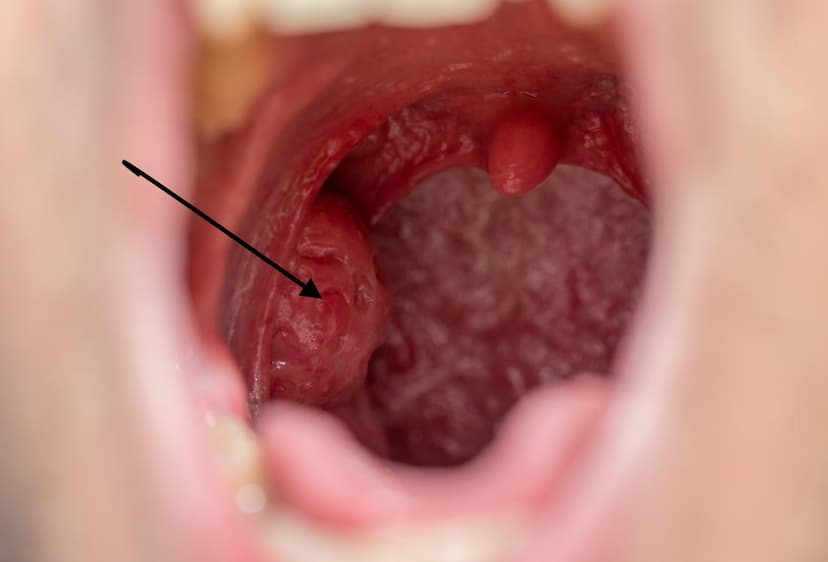 tonsils.jpg