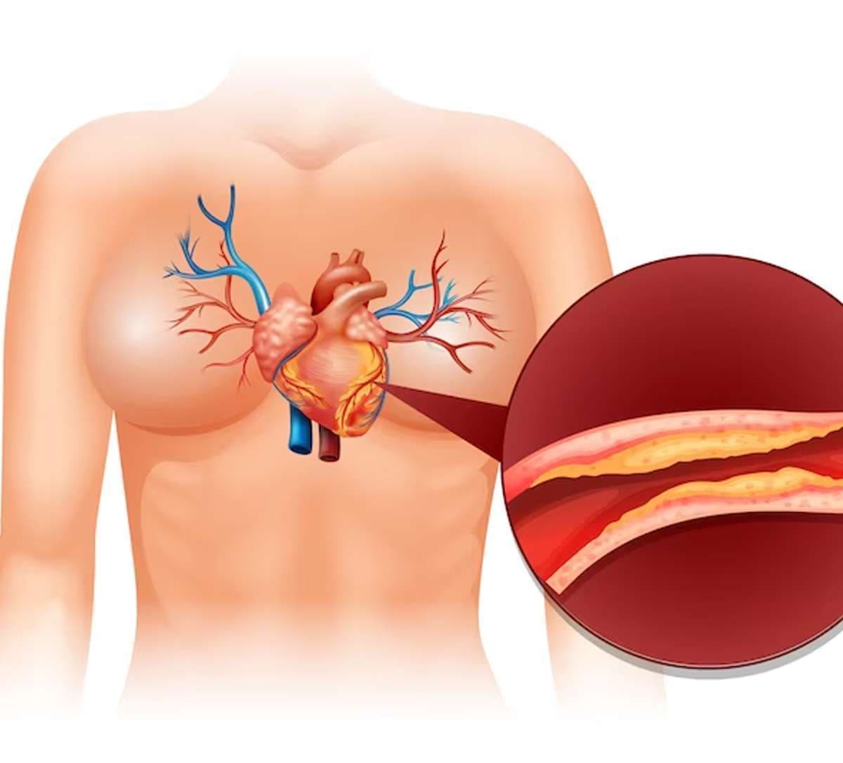 cholesterol-sign.jpg