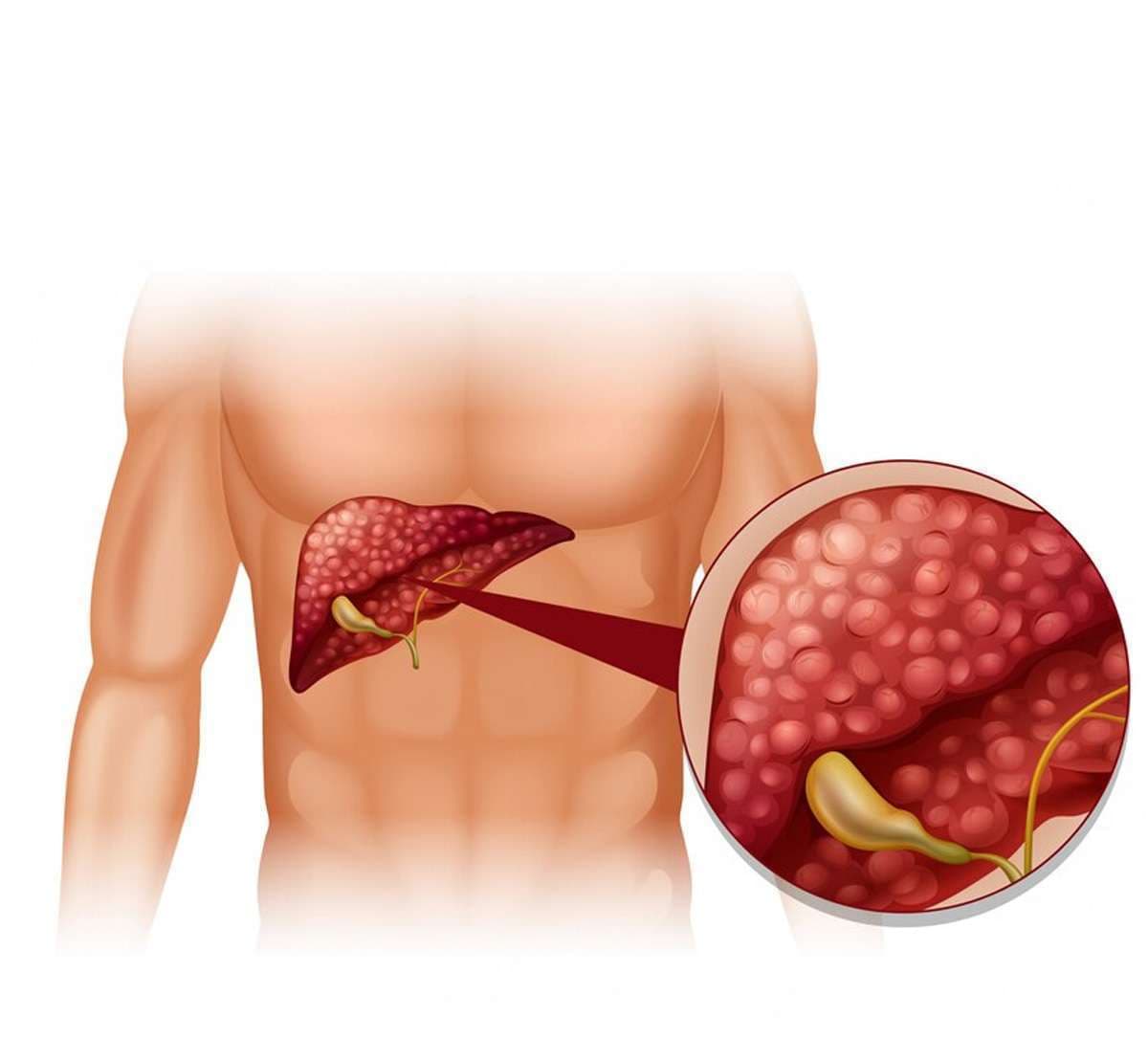 liver-cancer.jpg