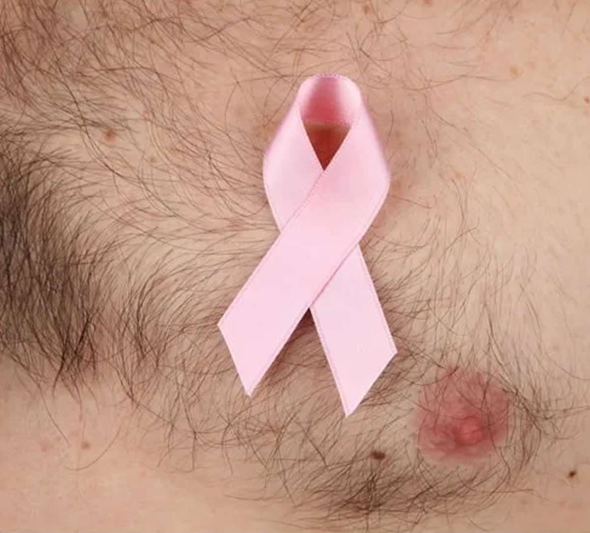 male-breast-cancer-treatmen.jpg