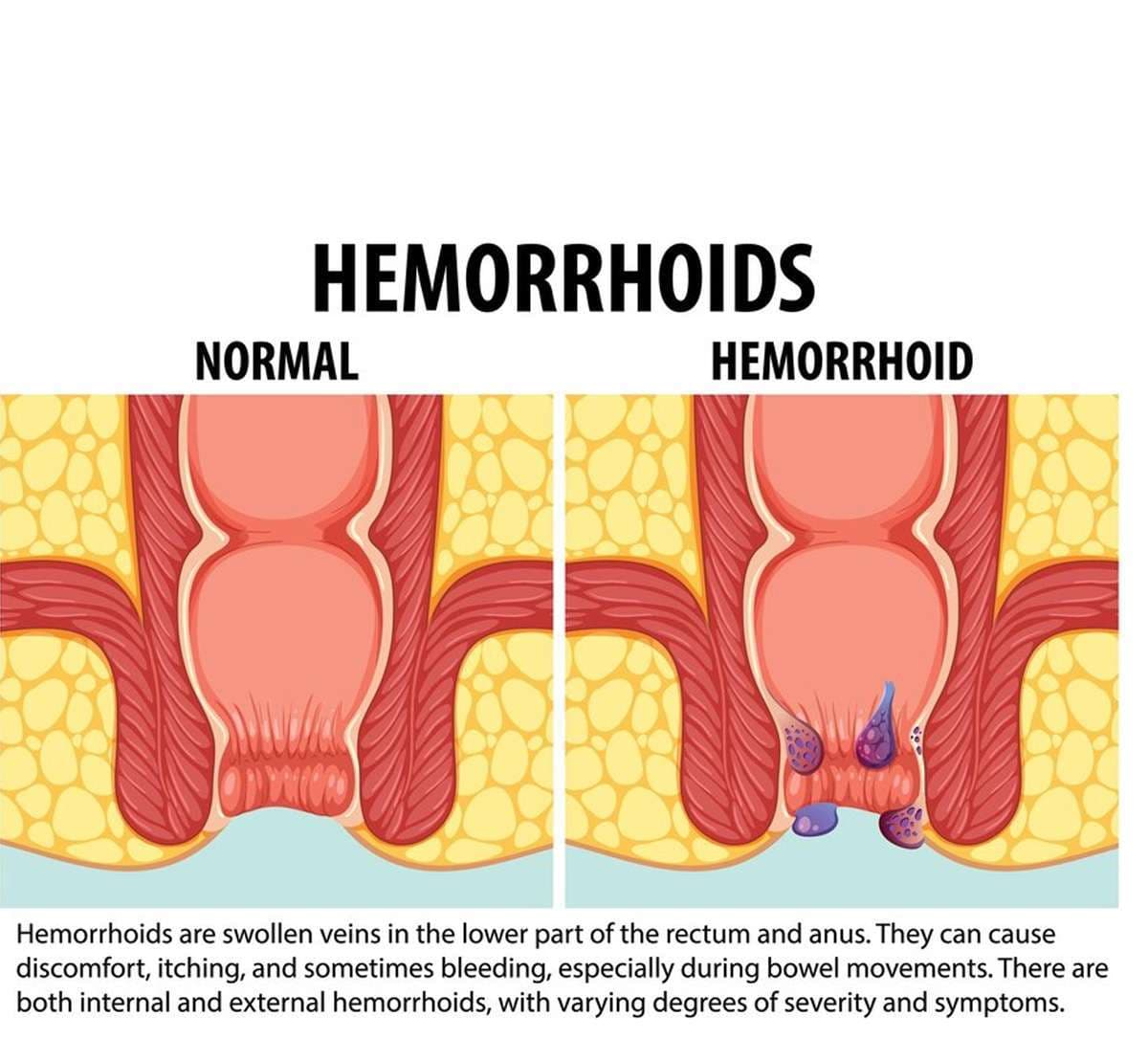 hemorrhoid.jpg