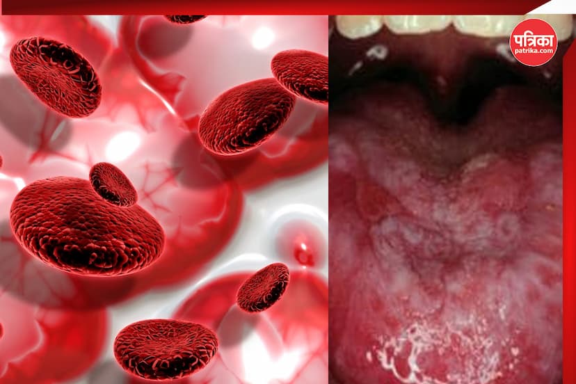 aplastic-anaemia.jpg