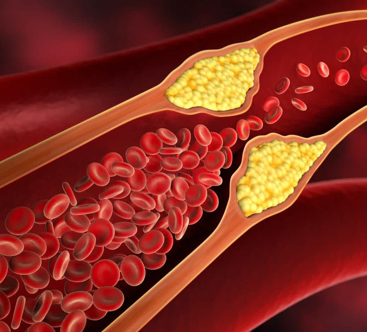 high cholesterol symptoms