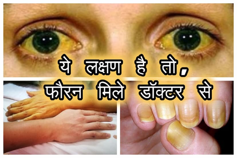 Jaundice case