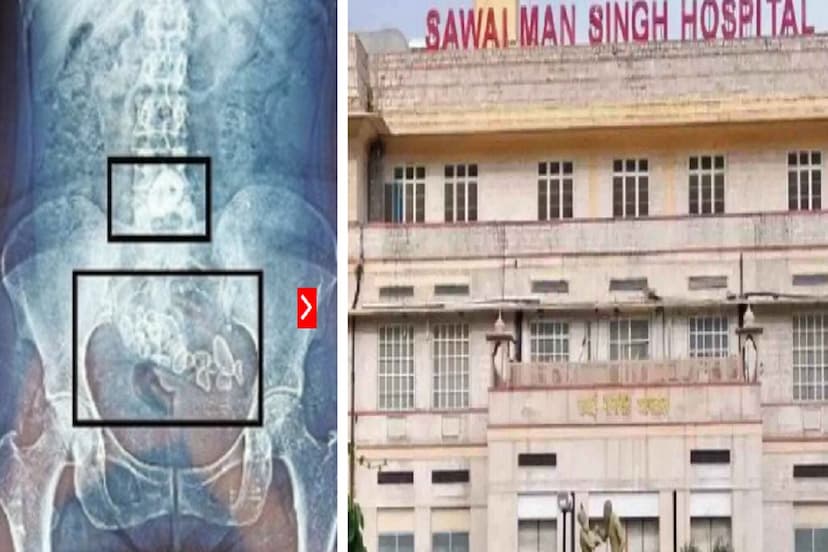 Sawai Man Singh Hospital Very Rare Operation 30 stones stuck in Gall Bladder and intestine were removed Patient Face was Happy