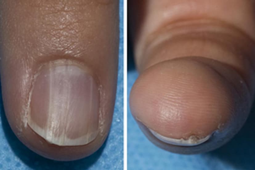 nail colour can signal cancer risk