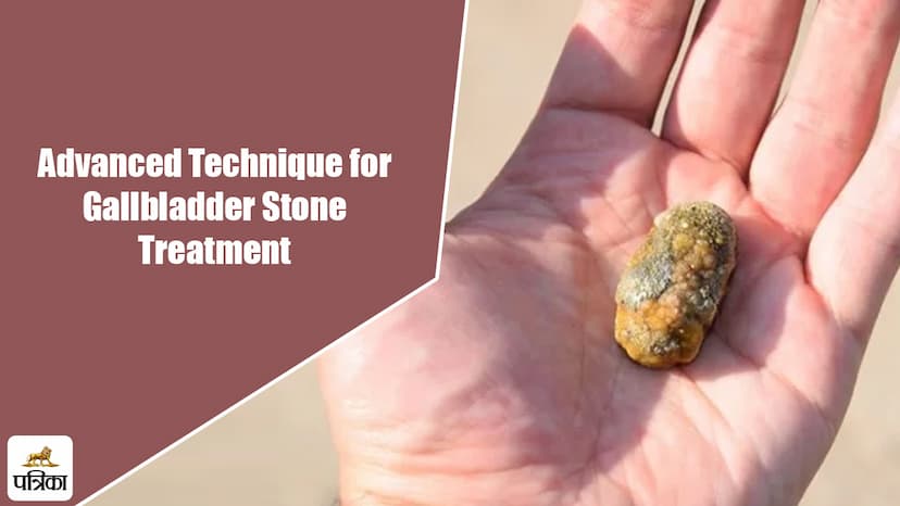 Advanced Technique for Gallbladder Stone Treatment