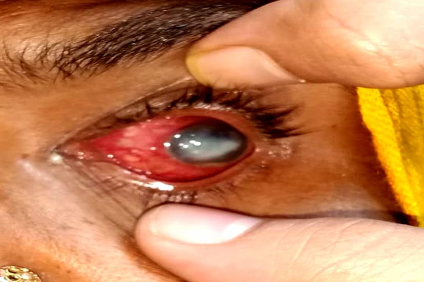 eye infection