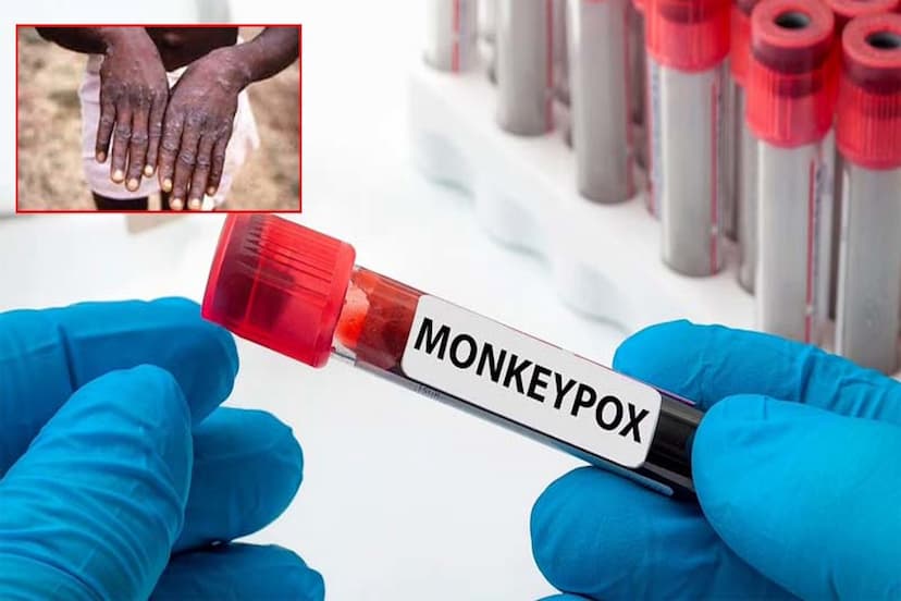 Monkeypox Alert