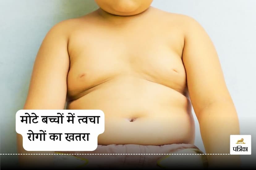 Childhood Obesity Linked to Higher Risk of Skin Diseases