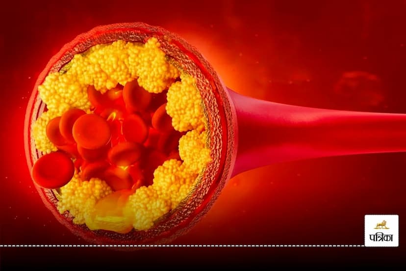 Bad cholesterol will be controlled in a month