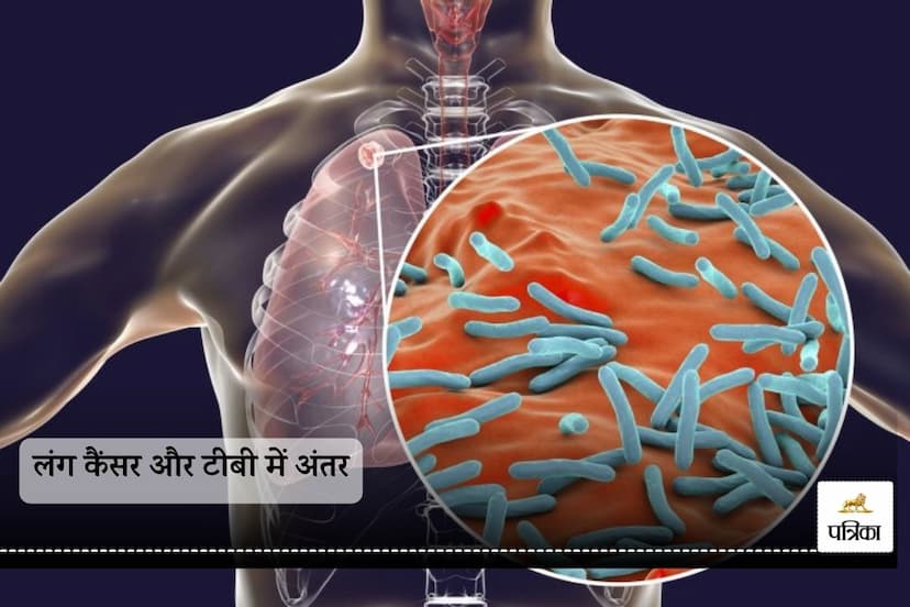 Difference between lung cancer and TB